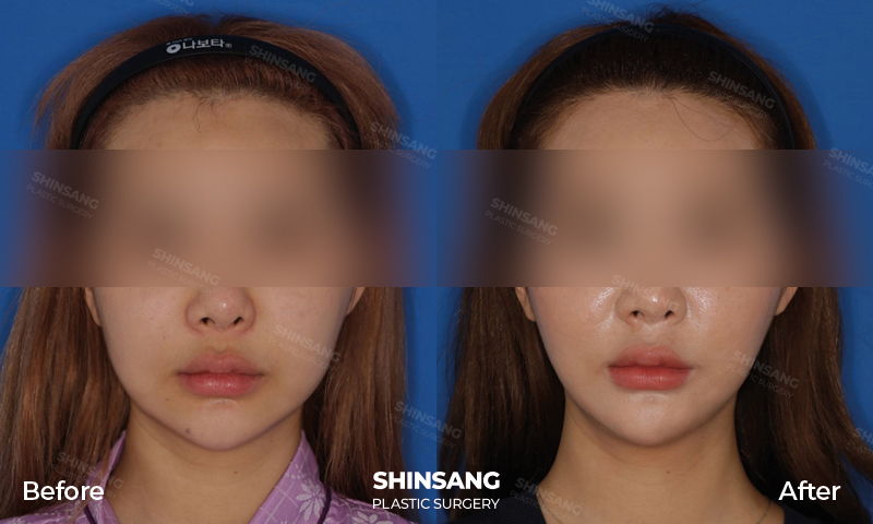 Jaw Botox Masseter Reduction Result At Sinsang Plastic Surgery In Korea