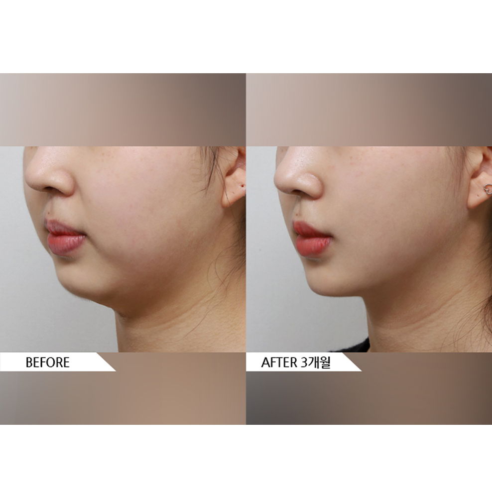 Before and after results of facial liposuction and thread lift showing a slimmer jawline and improved facial contour 3 months after treatment in Korea