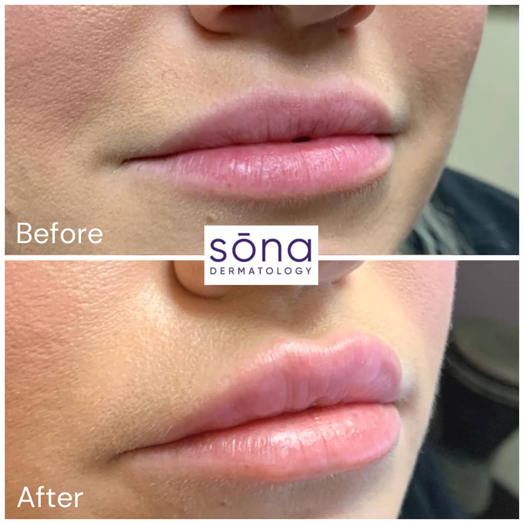 Sona Juvederm Lip Filler Before & After