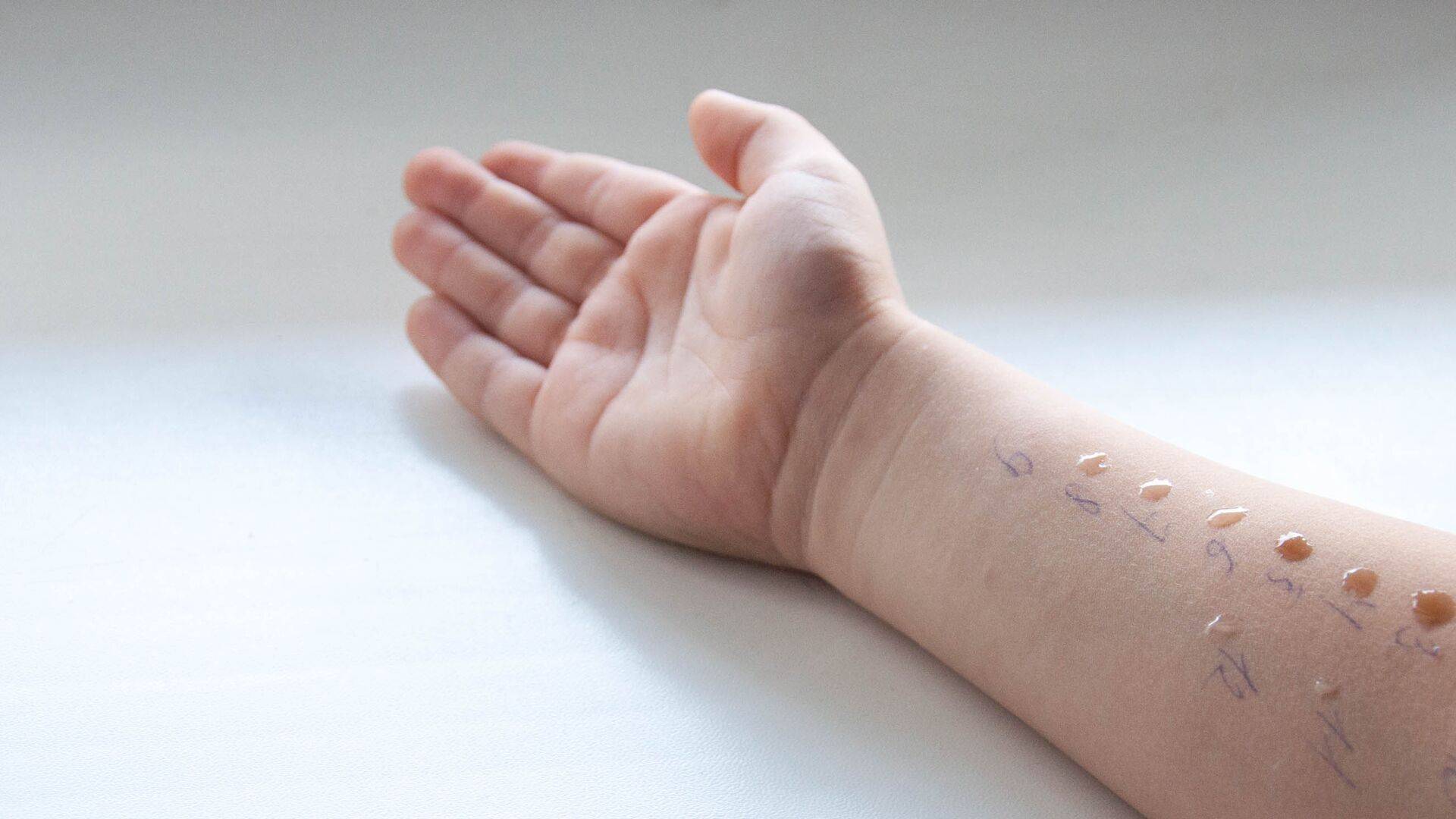 Child’s arm during a skin prick test – liquid drops containing allergens may cause a reaction like a mosquito bite