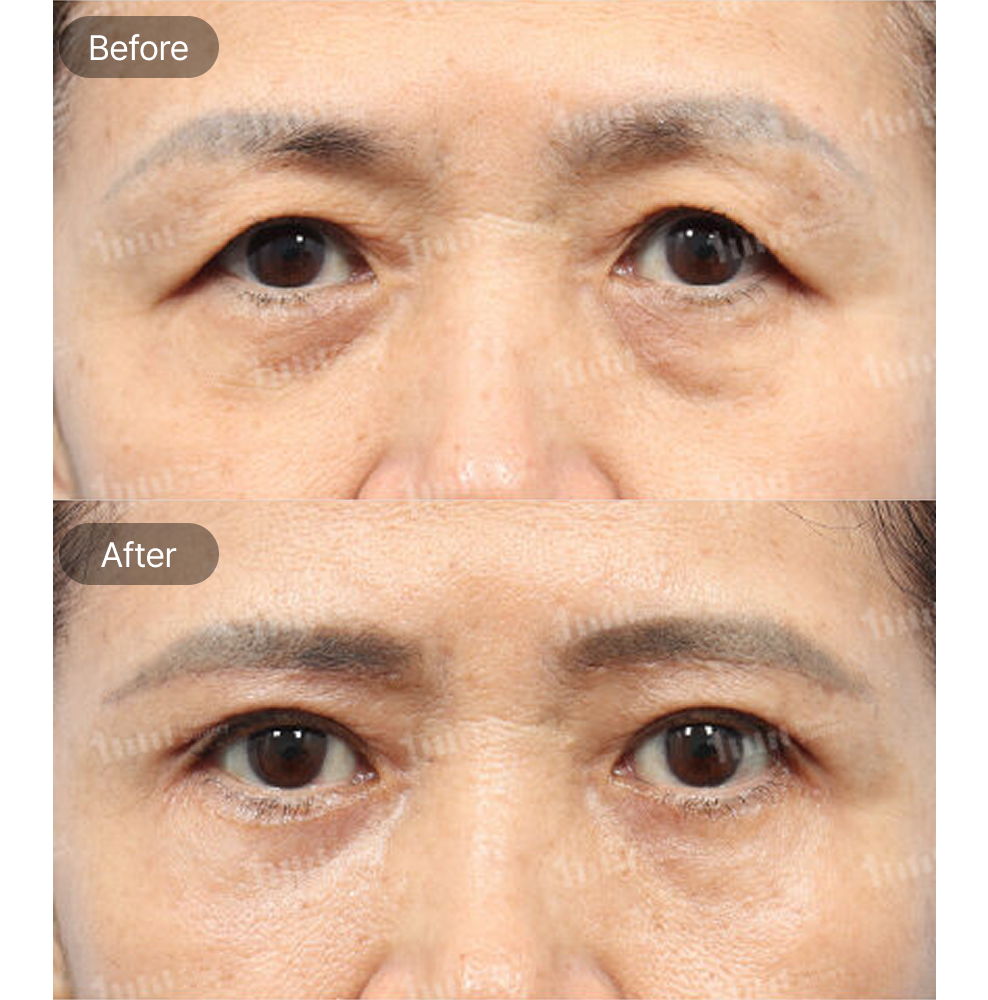 Brow Lift, Non-Incisional Lower Blepharoplasty Revision, and Under Eye Fat Grafting Before and After Results at 1MM Plastic Surgery in Korea