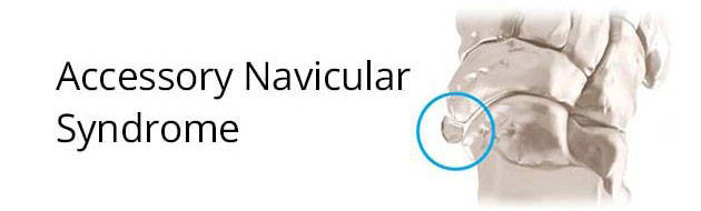Accessory navicular syndrome