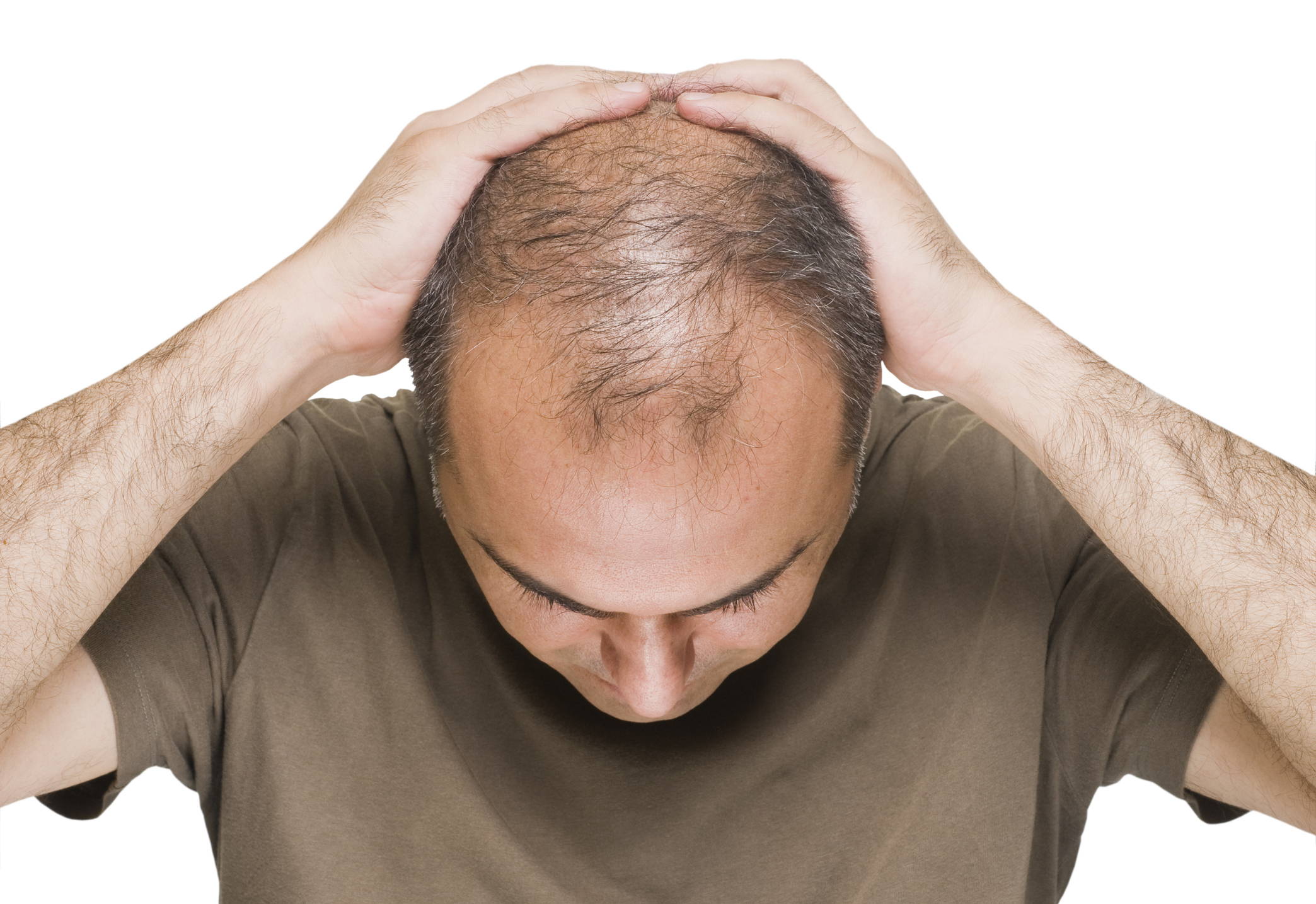 Is Male Pattern Baldness an Autoimmune Disease? – DS Healthcare Group