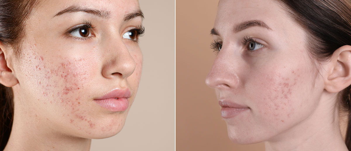 Two women with acne, shown from different angles.