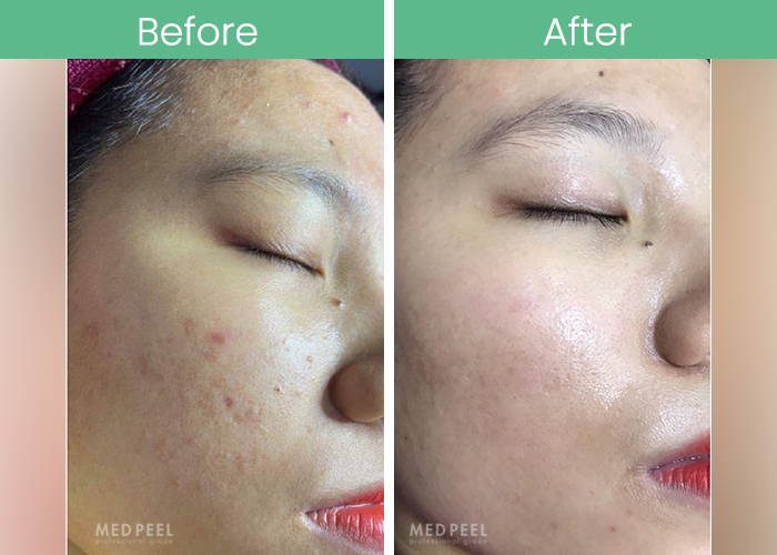 Salicylic Peel Before & After