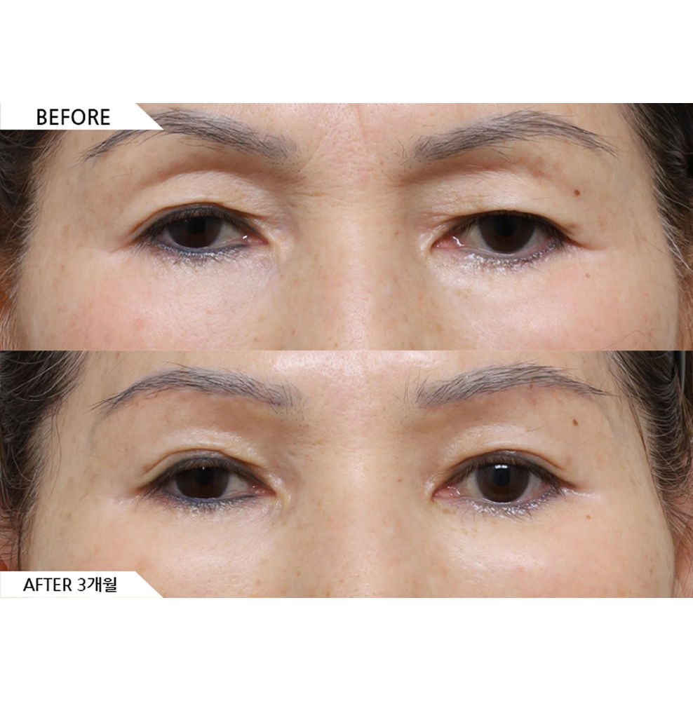 Before and after results of brow lift and upper eyelid lifting showing improved sagging eyelids and more youthful eyes in Korea