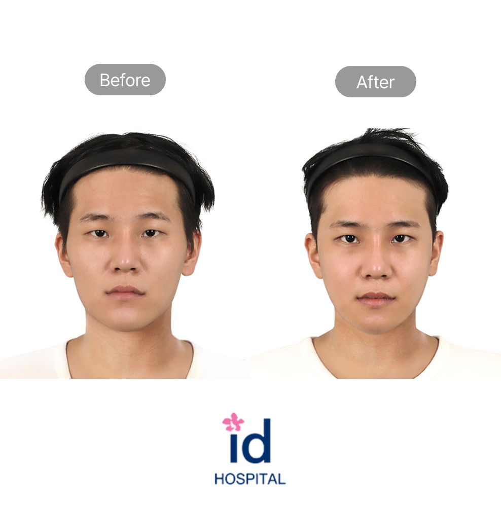 Male Eye Reshaping and Incisional Canthoplasty Before and After Result at ID Hospital
