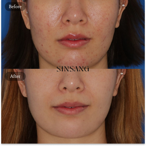 Sensitive Skin Barrier Repair Treatment Before and After in Korea