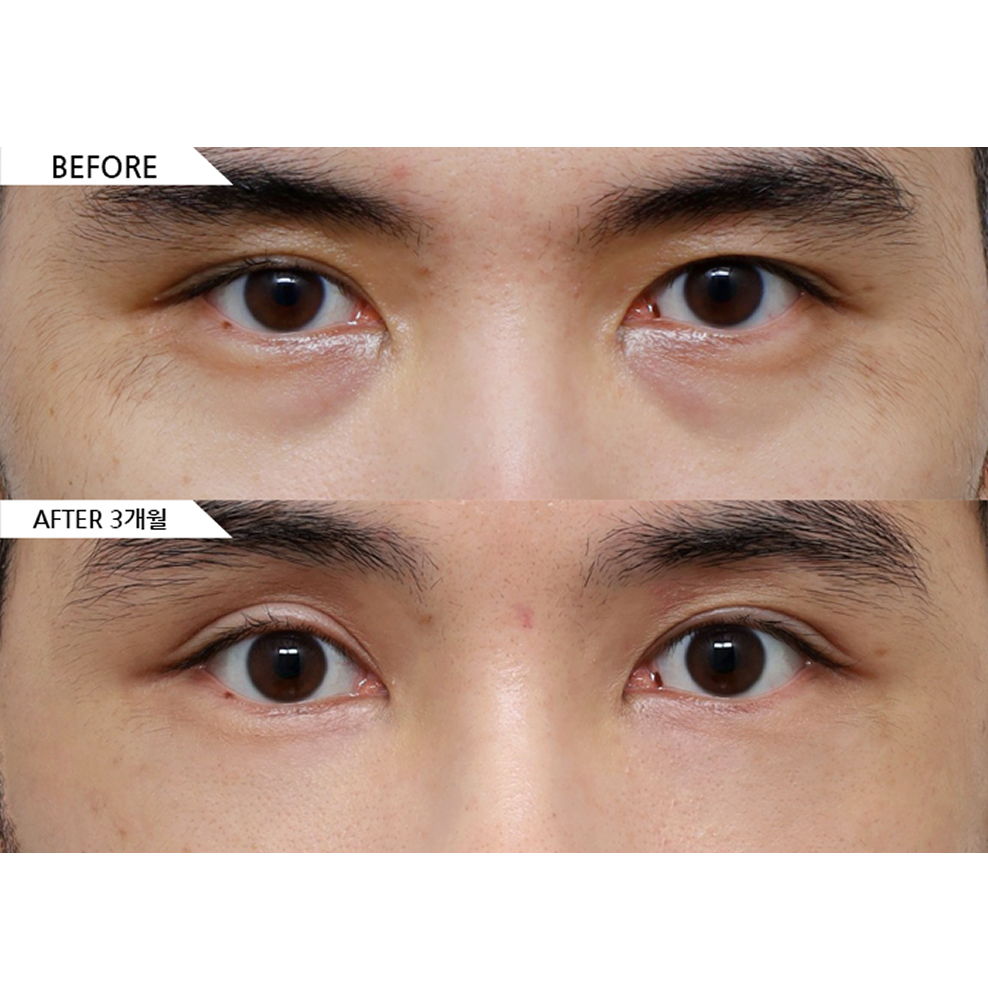 Before and after male eyelid surgery with under eye fat repositioning showing reduced dark circles and brighter eye area 3 months after surgery in Korea