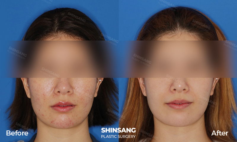 Scar Treatment Patient Review And Result At Sinsang Plastic Surgery In Korea