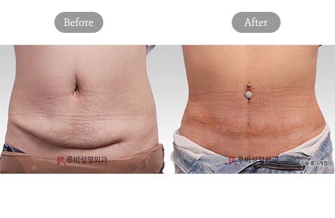 Mommy Makeover Korea Tummy Tuck Before and After Results at Ruby Plastic Surgery Clinic
