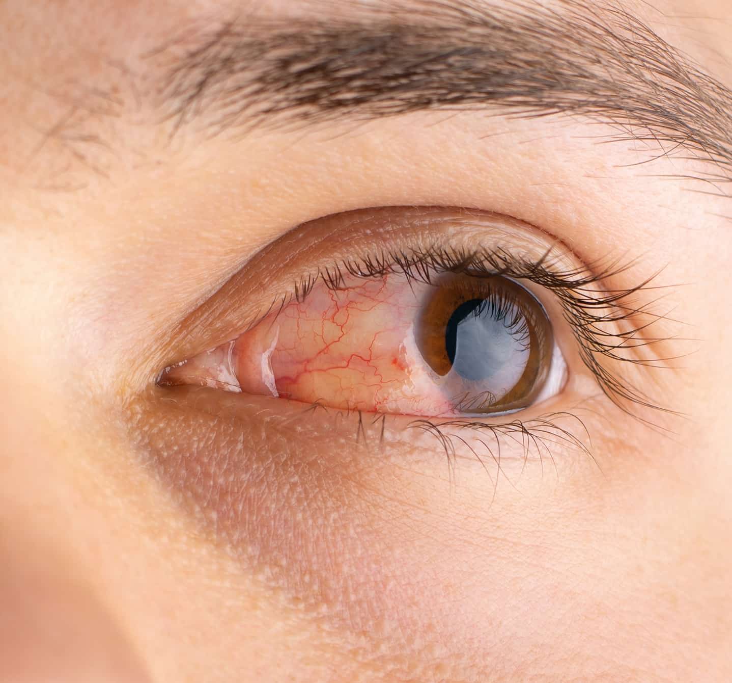 Nahaufnahme eines braunen Auges mit allergischer Bindehautentzündung; es tränt und ist gereizt.