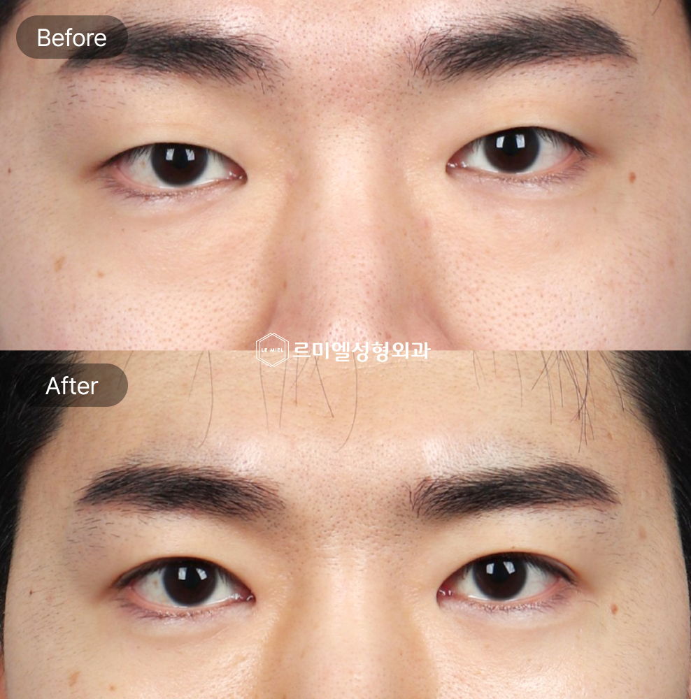 Before and After Results of Under Eye Fat Repositioning, Non Incisional Ptosis Correction, and Epicanthoplasty After Four Months