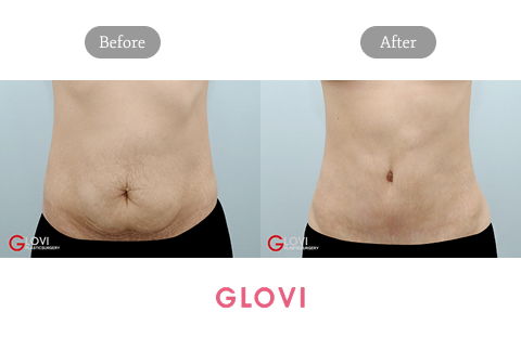 Abdominoplasty Results Before and After in Korea for Mommy Makeover Packages at Glovi Plastic Surgery Clinic