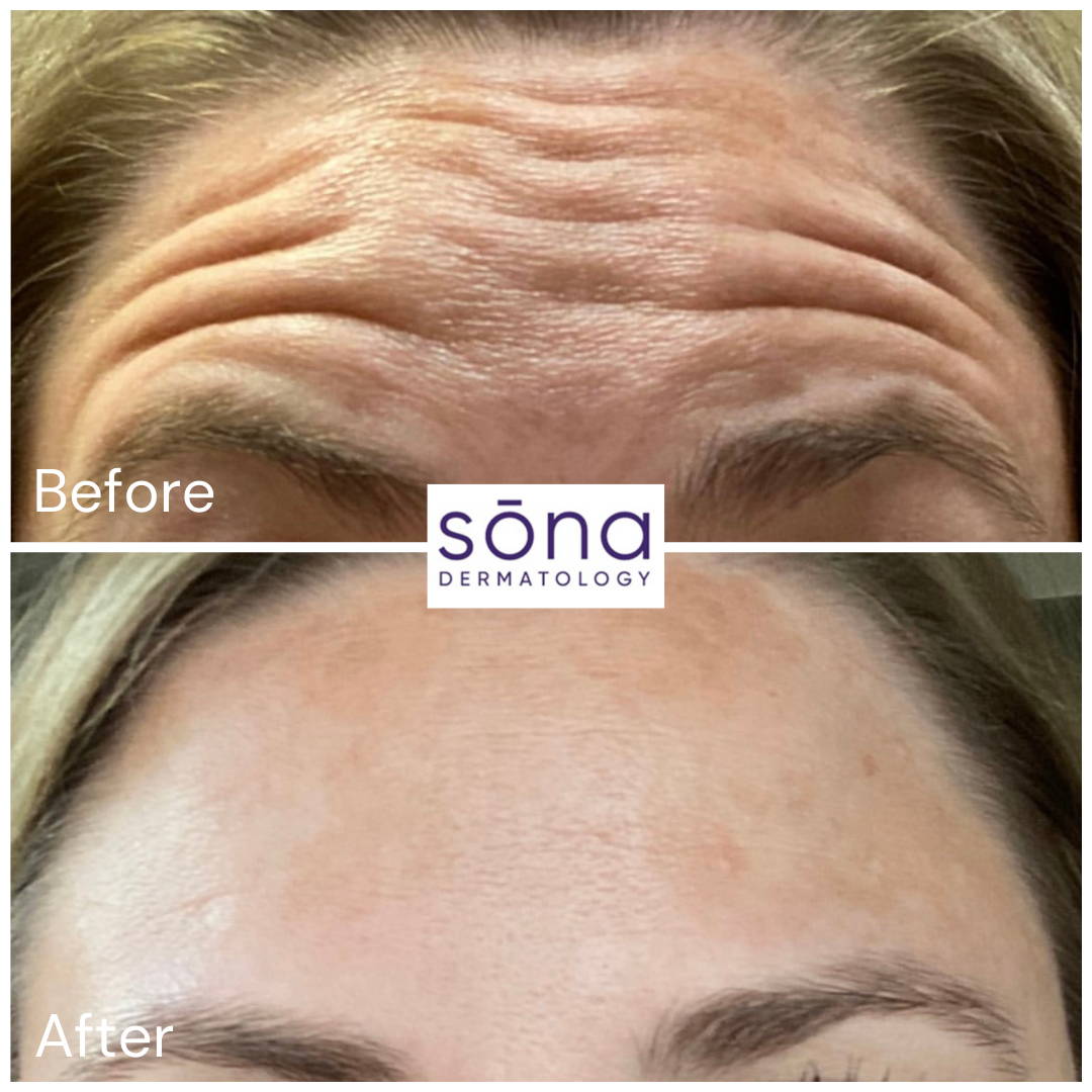 Sona Botox Cosmetic Before & After