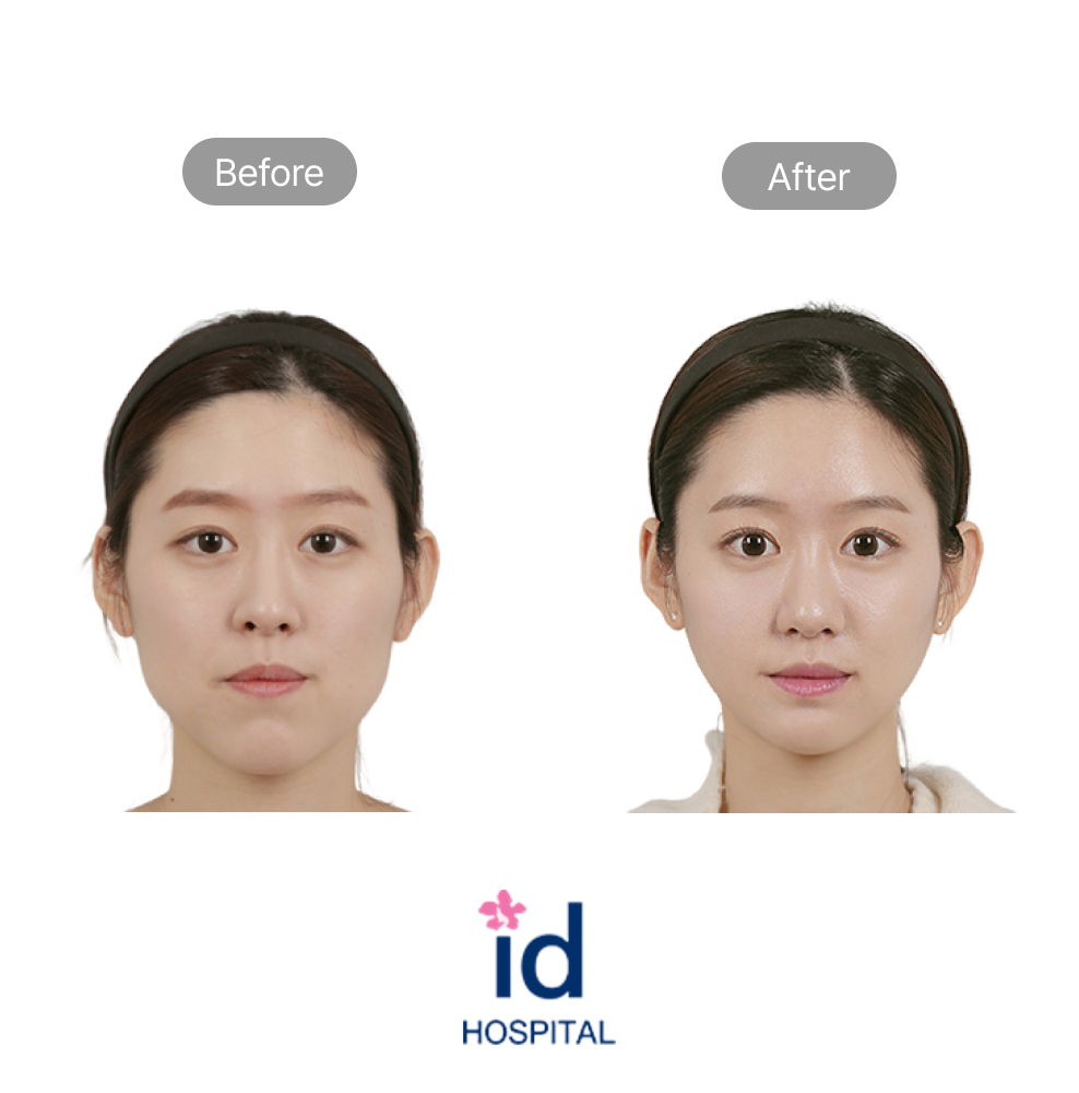 No-Tie Double Jaw Surgery and V-Logic Chin Surgery Before and After at ID Hospital