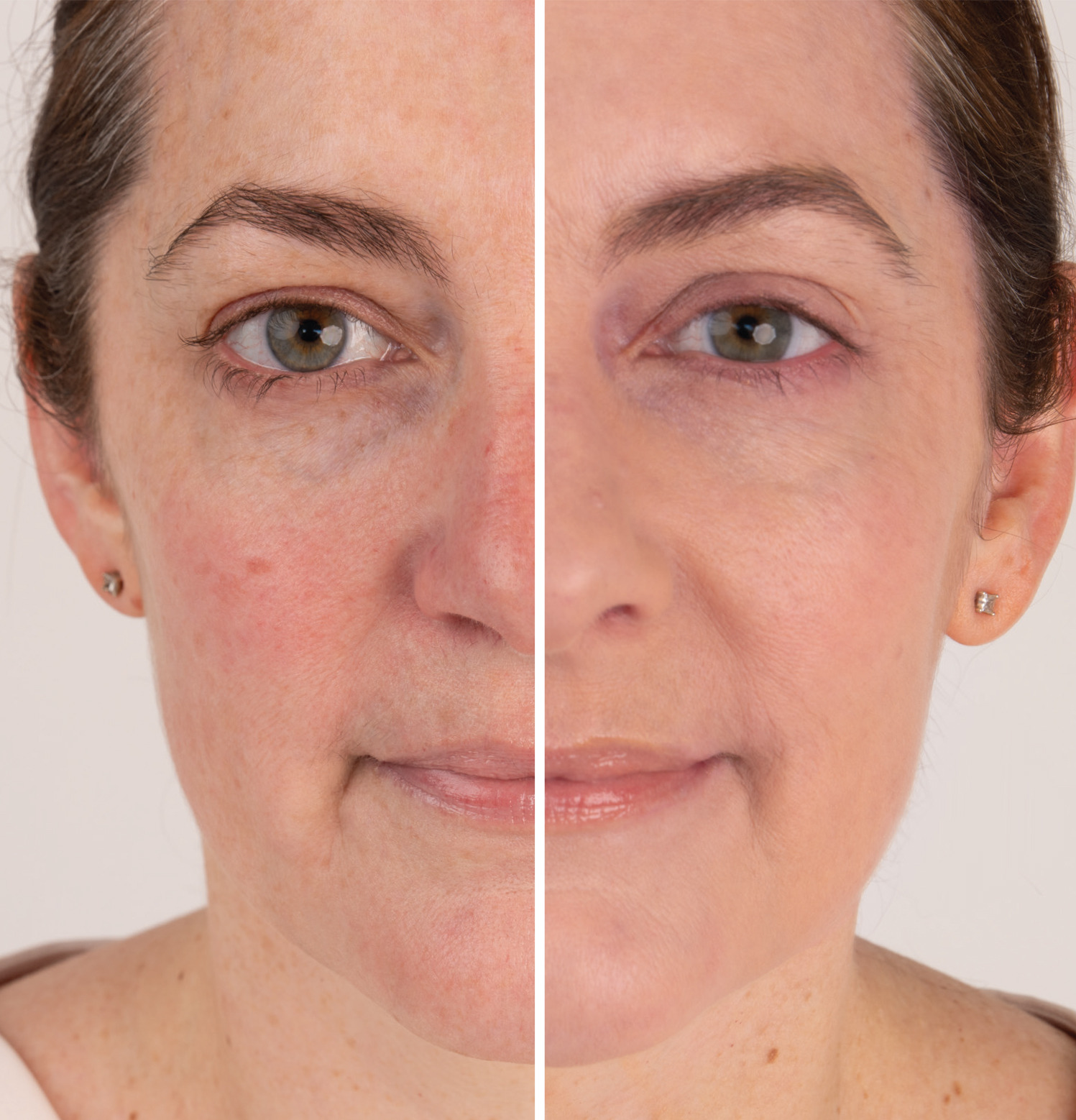Before and after comparison of facial skin appearance.