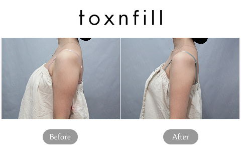 Noninvasive Liposuction Arm Body Fat Reduction Before and After Results After 2 Weeks