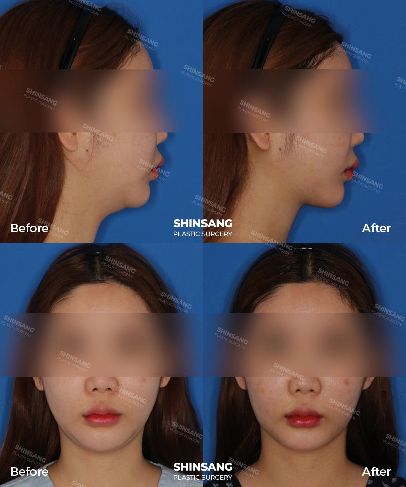 Double Chin Liposuction And Platysma Muscle Tightening Before And After Results At Sinsang Plastic Surgery In Korea