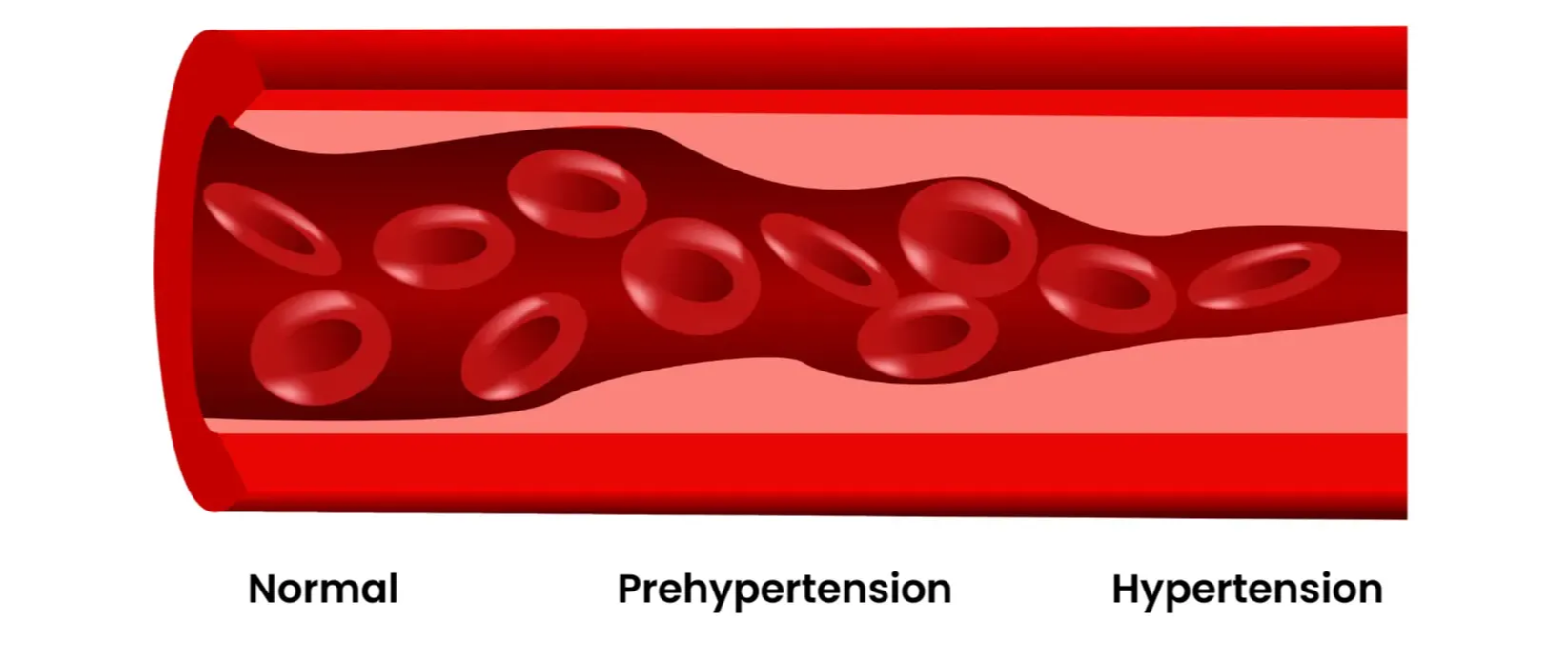 Animated graphic showing the progression of hypertension (high blood pressure). Norma > Prehypertension > Hypertension.