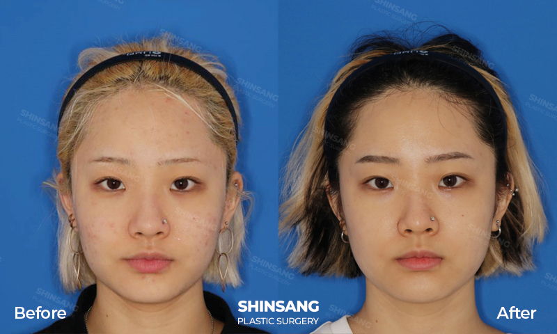 Acne Treatment Before And After Skin Result At Sinsang Plastic Surgery In Korea