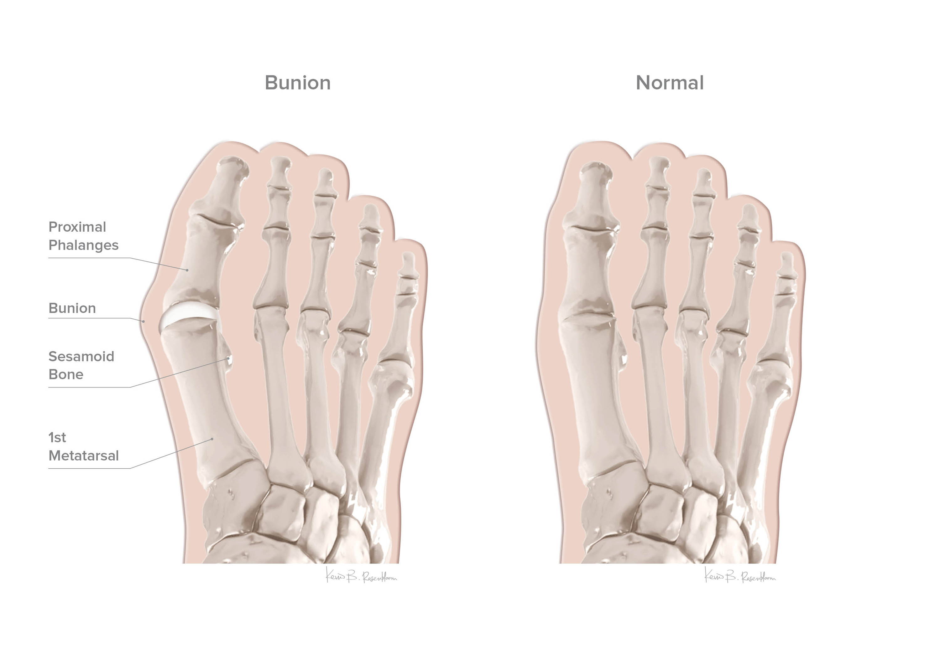 Hallux Valgus or Bunions