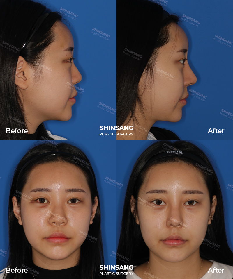 Nasal Bridge Augmentation And Tip Plasty Result At Sinsang Plastic Surgery In Korea