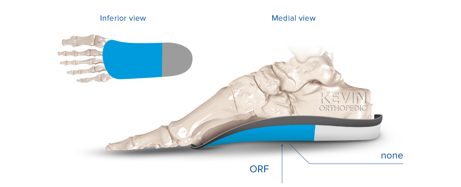 THE CLINIC GUIDE: FRAME MODIFICATIONS - Filler Skive – Kevin Orthopedic ...