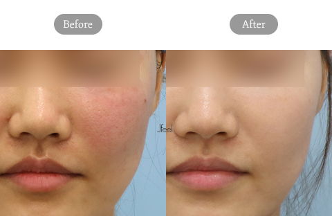 Rejuran Healer treatment results showing skin repair and redness improvement as a Korean filler alternative in Seoul clinics