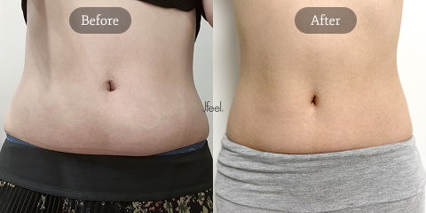 Non-Surgical Body Contouring in Korea for Waistline Slimming and Natural Fat Reduction After Cryolipolysis Treatment