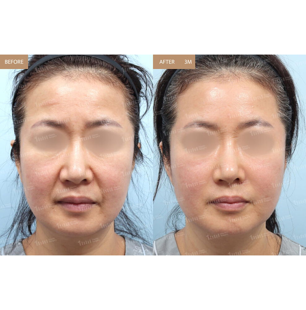 Midlife Full Face Fat Grafting Before and After Results at 1MM Plastic Surgery in Korea for Restored Facial Volume and Youthful Contours