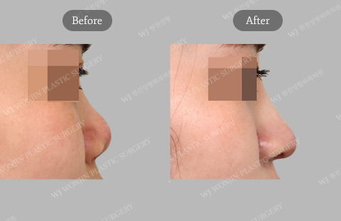 Revision rhinoplasty correcting upturned nose with improved nasal projection and balanced profile result in Korea