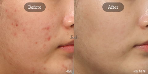 Exosome Therapy for Acne Inflammation Control and Post-Laser Skin Recovery in Korean Dermatology Clinics