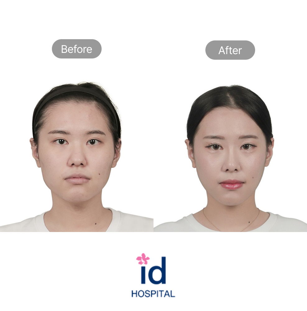 Single Facial Contouring and Cheekbone Reduction Before and After Result at ID Hospital