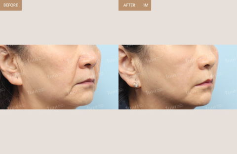 Face Lift Using Threads 1 Month After – Jawline Thread Lift Result in Korea by Jivaka Beauty