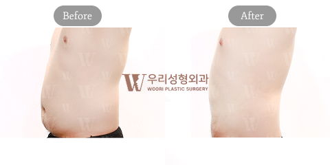 Male Plastic Surgery in Korea Featuring High-Definition Liposuction for Athletic Body Contouring and Masculine Definition