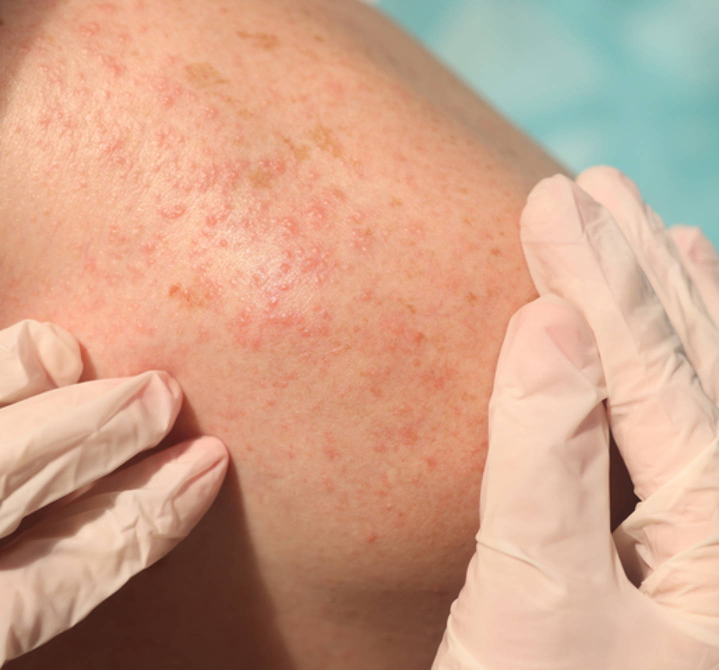 Close up of a shoulder with a rash being inspected by someone in surgical gloves. It could be allergic reaction heat rash.