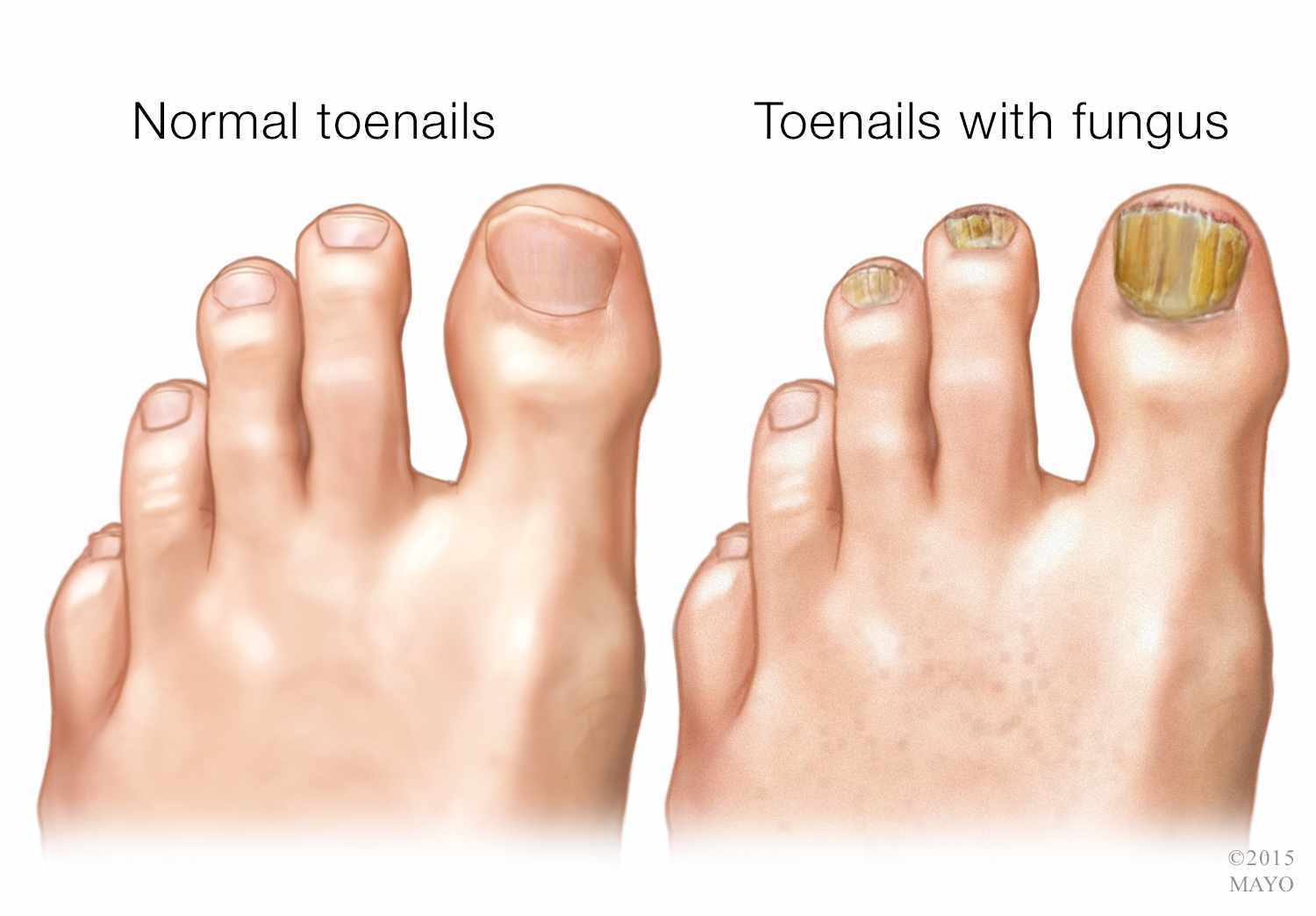 How To Get Rid Of Nail Fungus | Premier Foot & Ankle Center