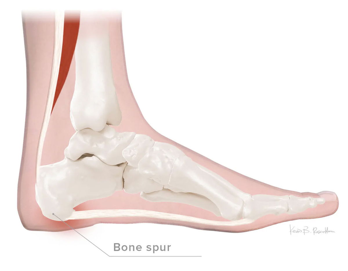 Heel spur anatomy — lateral view of calcaneus and plantar fascia