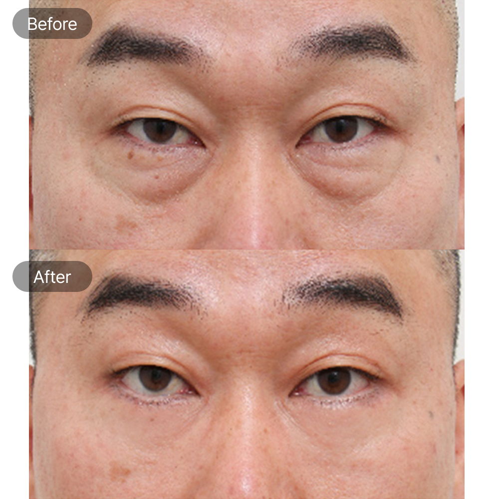 Male under eye bag surgery before and after results at Fresh Dr. Hong Plastic Surgery in Korea
