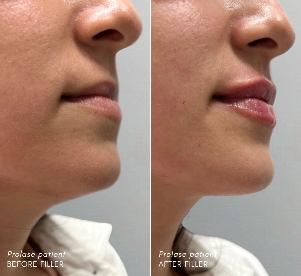 Prolase Patient before and after 1ml Juvederm ultra plus Nurse Isabel