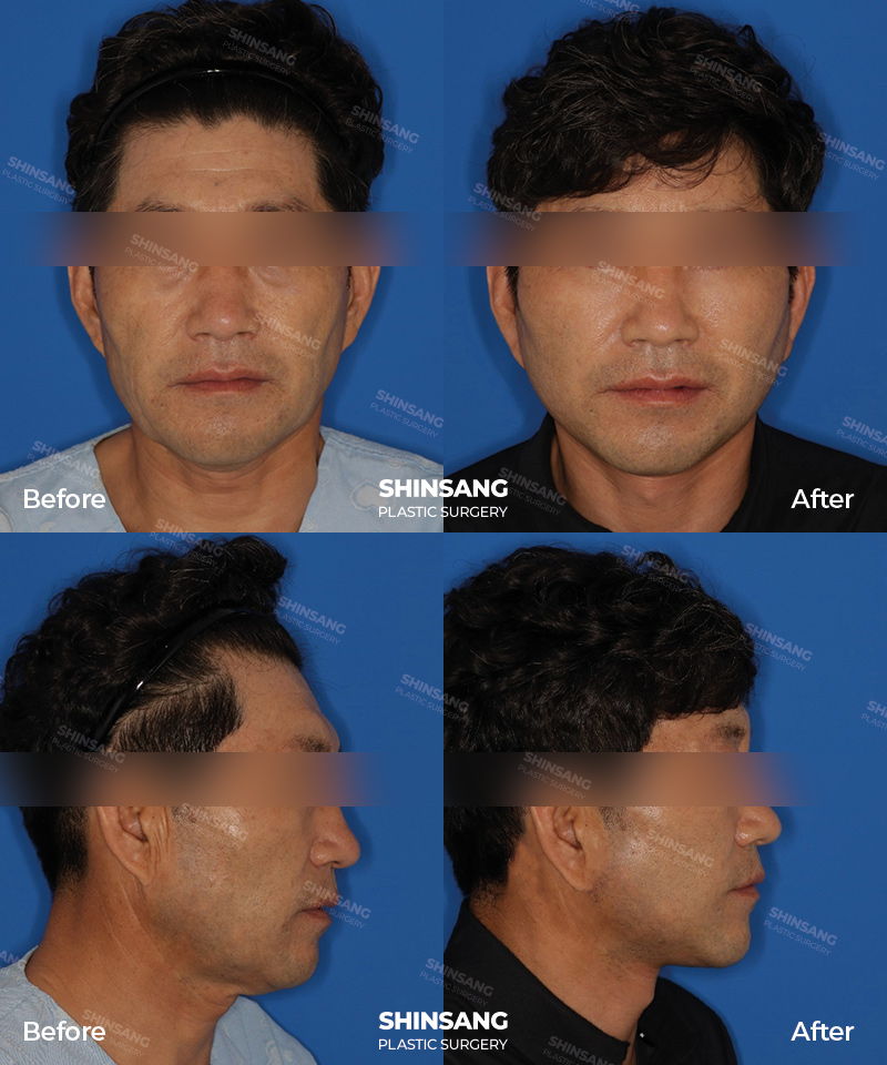 Full Facelift With Full Face Fat Grafting Result At Sinsang Plastic Surgery In Korea