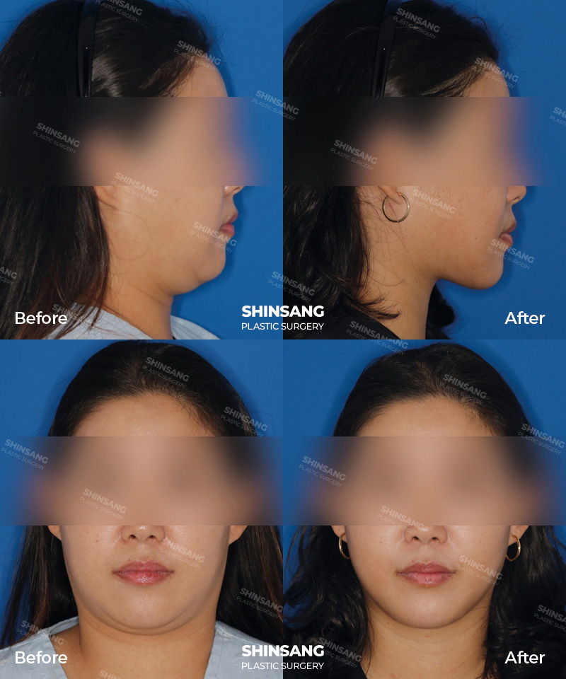 Chin Fixation And Neck Contouring Result Review At Sinsang Plastic Surgery In Korea