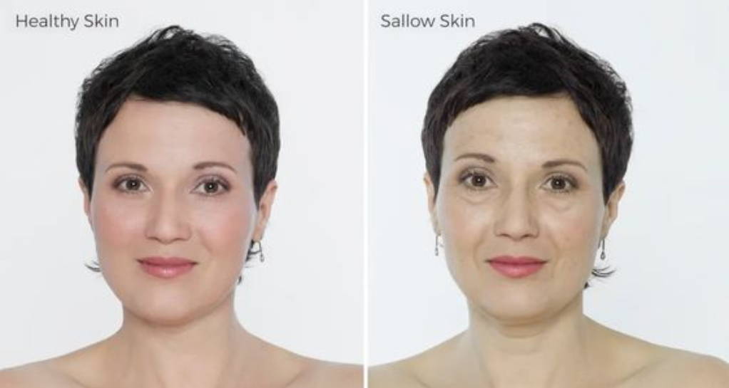 sallow skin before and after image
