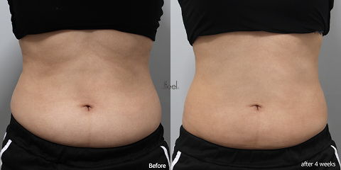 Non-Surgical Body Contouring in Korea with RF Body Tightening for Skin Firming and Post-Weight-Loss Body Shaping