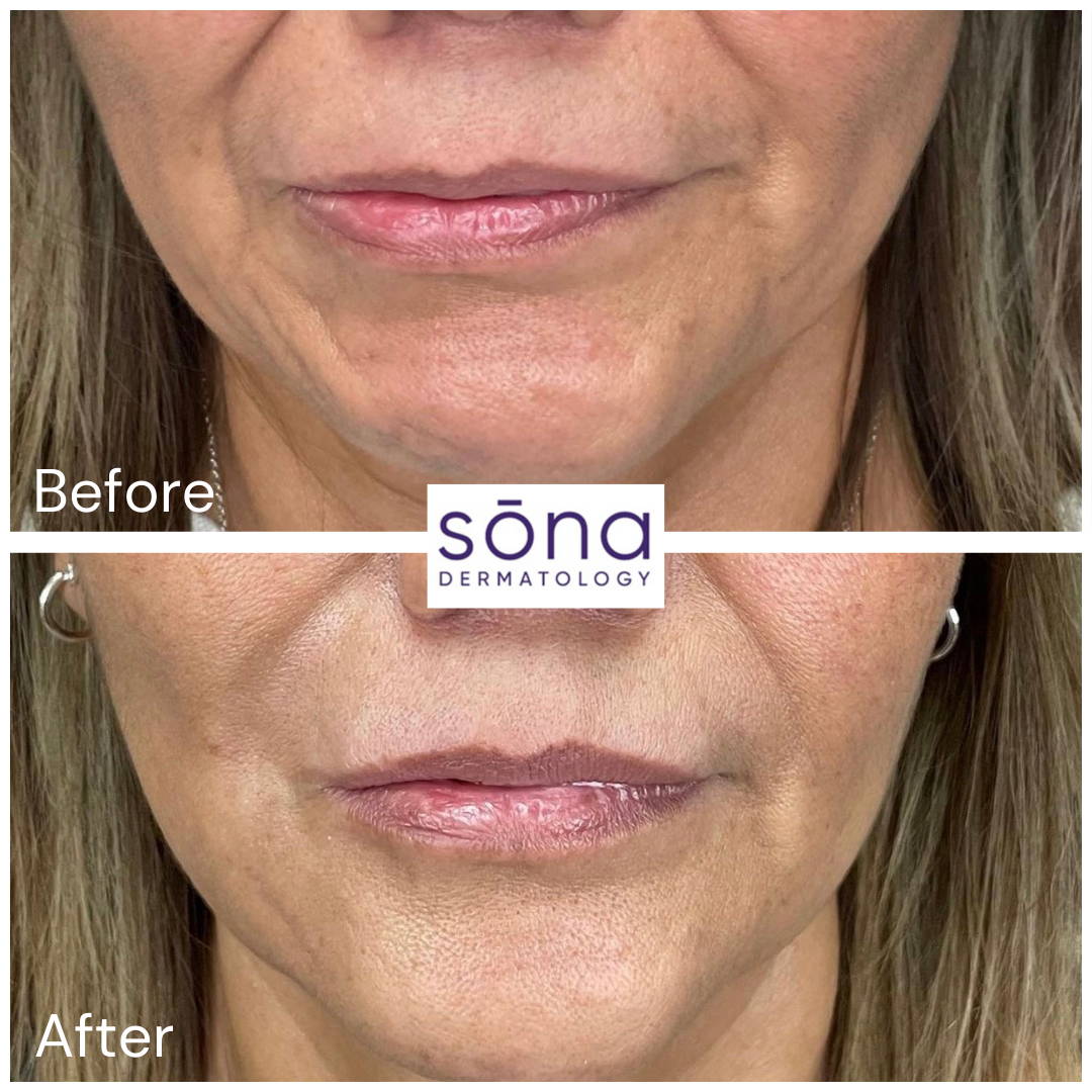 Sona Juvederm Facial Filler Before & After