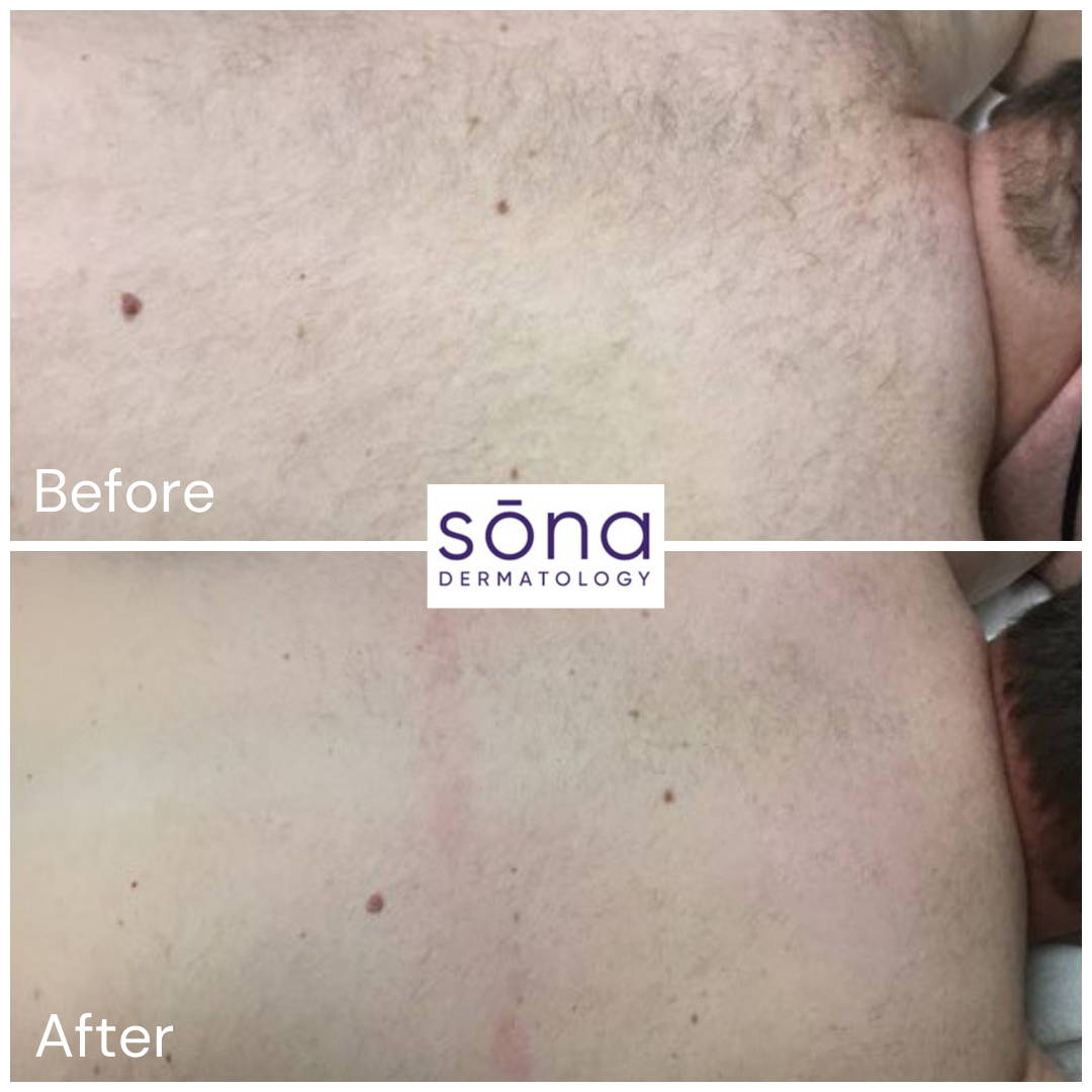 Sona Motus AY Laser Hair Removal Before & After 2