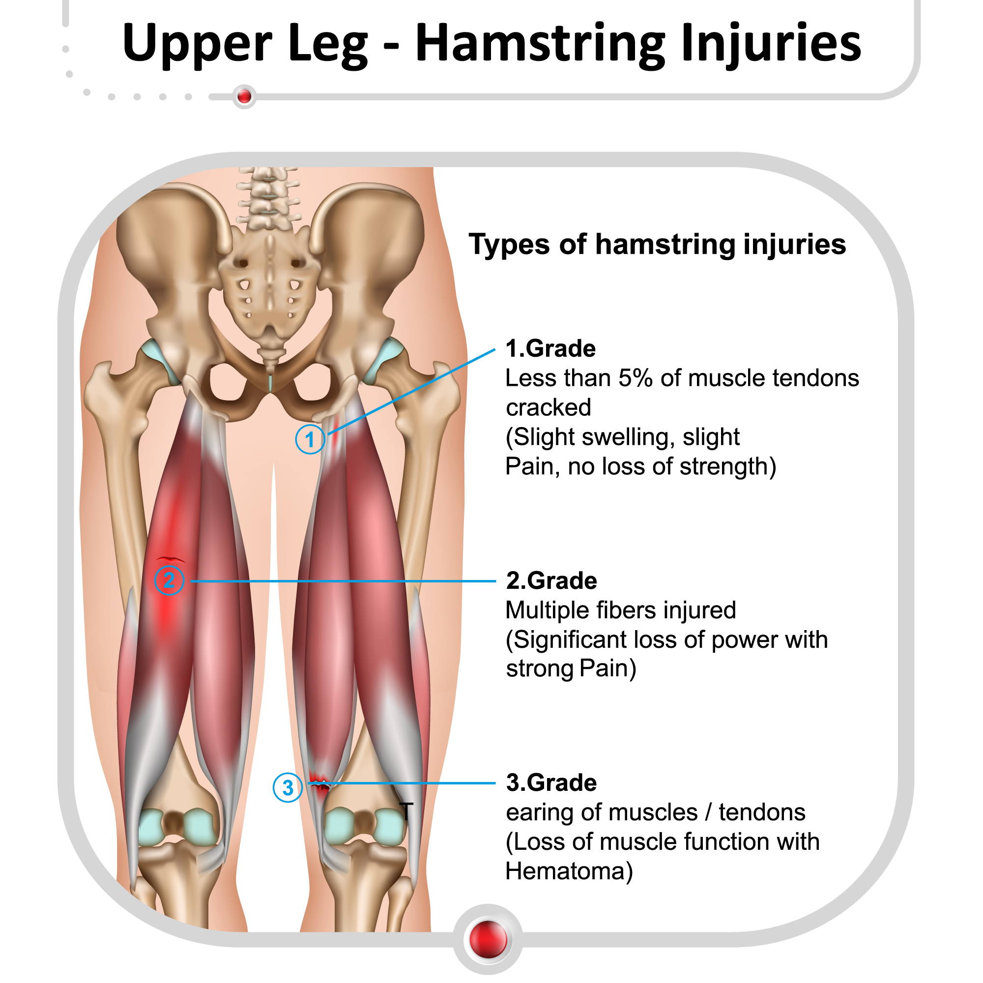 Upper Leg Pain – Kinesiology Sports Tape