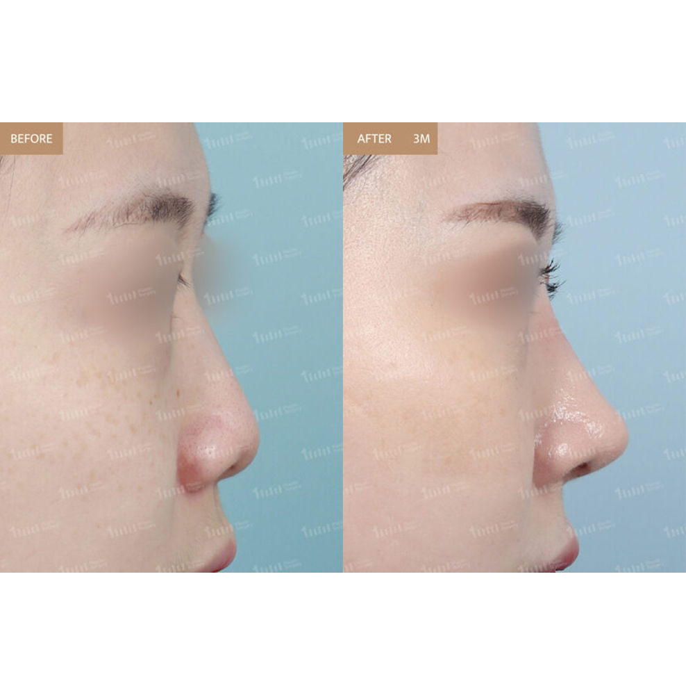 Rhinoplasty Before and After Results at 1MM Plastic Surgery in Korea for a Balanced and Refined Nose Profile