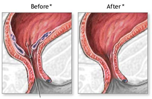 A before and after picture of a rectum